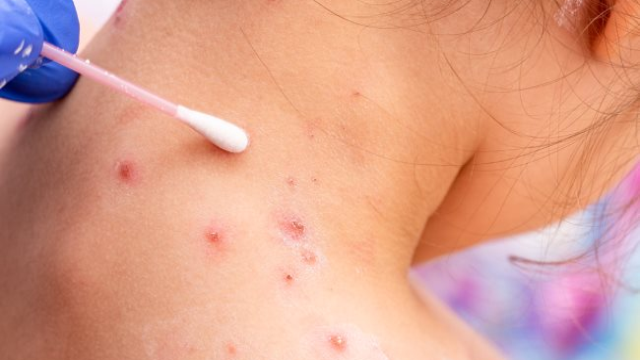 Penyebab Kulit Gatal Berair yang Wajib Banget Kamu Tahu, Tetap Waspada!